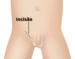 Estrangulamento-da-Hérnia-Dr-Antonio-Heinisch-Cirurgiao-Pediatrico